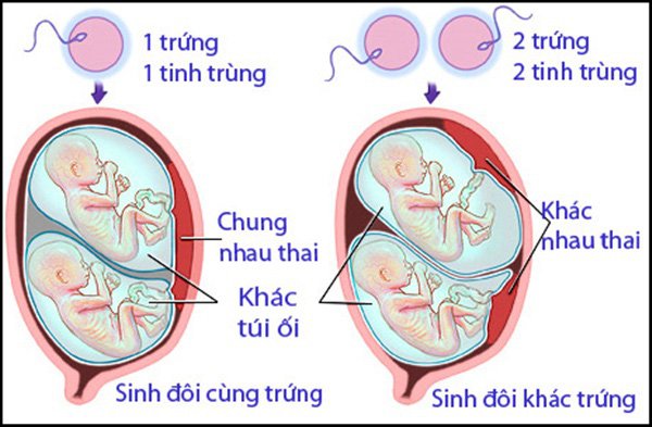 Phân biệt sinh đôi cùng trứng và sinh đôi khác trứng.