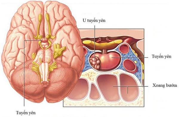 bệnh lý thường gặp ở tuyến yên