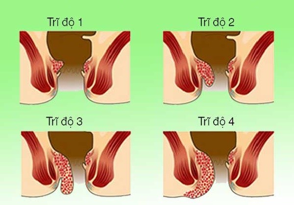 4 mức độ của bệnh trĩ nội