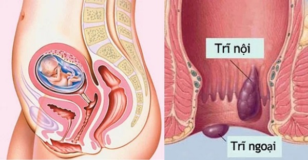 Mẹ bầu bị trĩ khi mang thai thường sẽ tự khỏi sau khi sinh