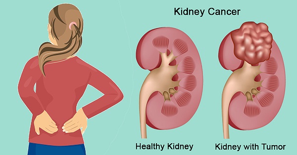 Những cơn đau lưng có thể là dấu hiệu ung thư thận