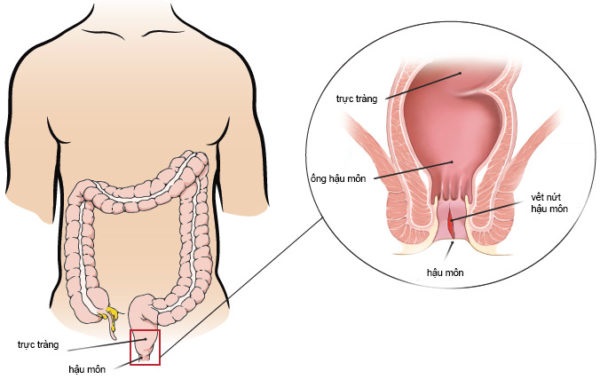 Vết rách trên niêm mạc hậu môn gây tình trạng nứt kẽ hậu môn