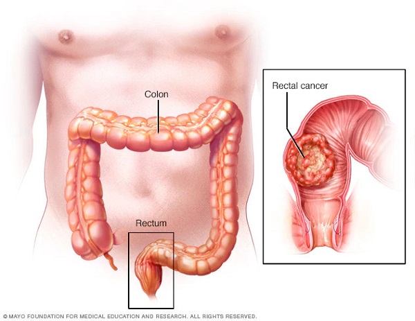 Ung thư trực tràng thường có tiên lượng tốt nếu được chẩn đoán sớm