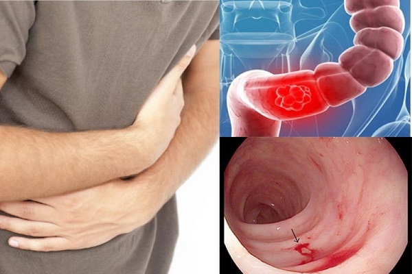 Xuất huyết tiêu hóa là một trong những biến chứng vô cùng nguy hiểm của các bệnh lý tại ống tiêu hóa