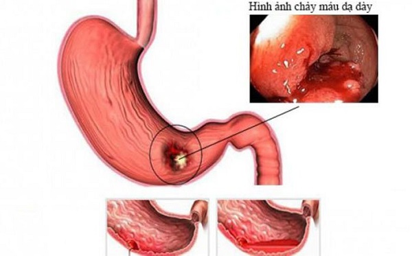 Viêm loét dạ dày - tá tràng là nguyên nhân chính gây chảy máu dạ dày