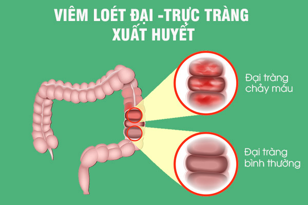 Một trong những nguyên nhân gây xuất huyết tiêu hóa dưới là viêm loét đại trực tràng xuất huyết