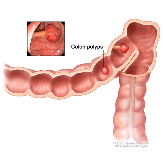 Polyp đại trực tràng có thể tiến triển thành ung thư