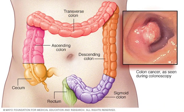 Câu hỏi đầu tiên mà người được chẩn đoán ung thư đại tràng đặt ra là “Ung thư đại tràng sống được bao lâu?”