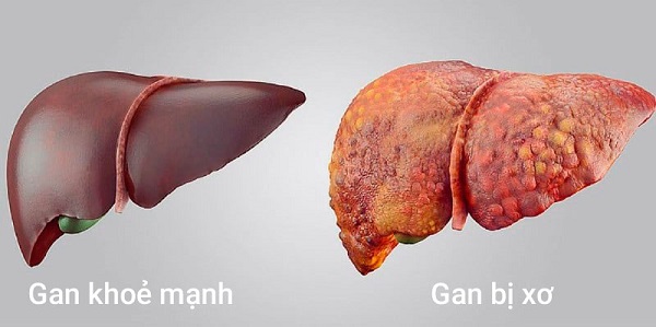 Xơ gan là nguyên nhân phổ biến dẫn đến giãn tĩnh mạch thực quản