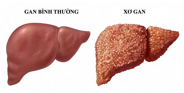 Xơ gan là hiện tượng xơ hóa gan do quá trình sửa chữa và phục hồi tổn thương ở gan
