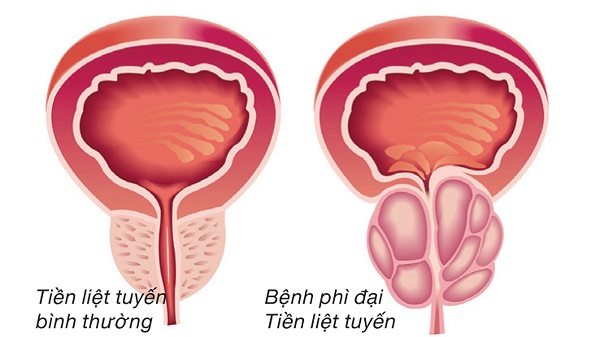 Phì đại tiền liệt tuyến