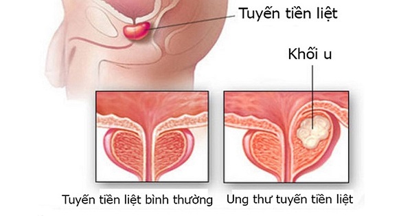 Phì đại tiền liệt tuyến gây ra những biến chứng nguy hiểm