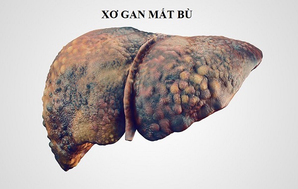 Xơ gan mất bù là tình trạng lá gan đã xơ hóa hoàn toàn