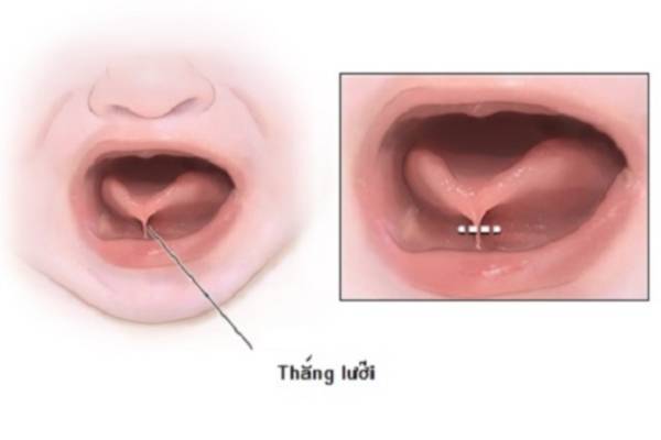 Dấu hiệu trẻ bị dính thắng lưỡi
