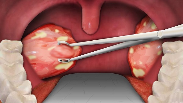 Ngứa họng ho là dấu hiệu của nhiều bệnh lý khác nhau