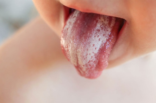 tưa lưỡi là gì
