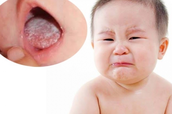 Biểu hiện của trẻ bị tưa lưỡi