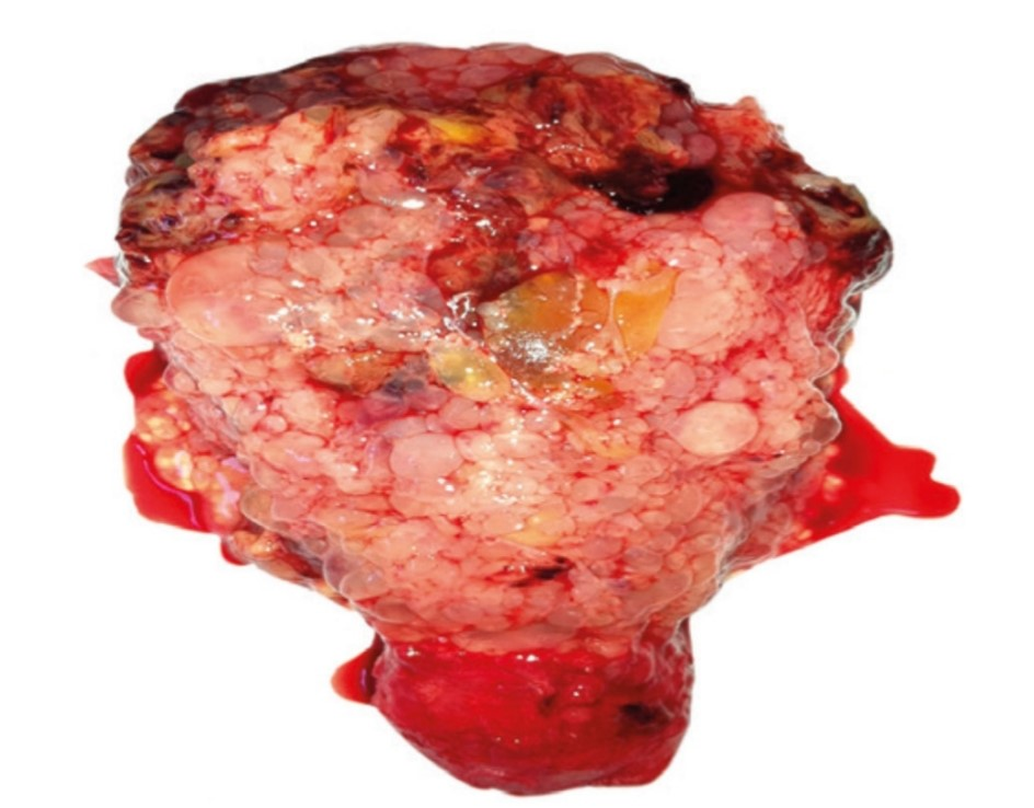 Figura 1: macroscopia da MHC. Perceba que há apenas presença das vilosidades, sem as partes fetais. Fonte: FEBRASGO, 2019