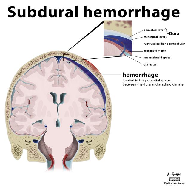 Representação da hemorragia subdural. É unilateral em 85% dos casos em adultos, mas em crianças, é bilateral em 75 a 85% dos casos. Os locais mais comuns de acometimento da lesão são na região frontoparietal e na fossa craniana média. Como é possível ver na figura, o hematoma normalmente ultrapassa as suturas cranianas. Fonte: Radiopaedia