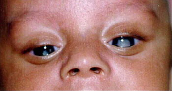 Presença de catarata, caracterizada por opacificação do cristalino. Fonte: Cohr Oftamologia (https://www.cohroftalmologia.com.br/itatiba/doencas-oculares/catarata-congenita)
