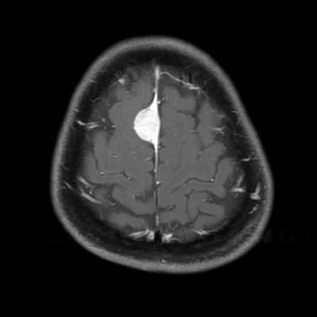 RM em T1, com saturação de gordura. Na imagem, é possível observar uma massa hiperintensa, formada devido ao espessamento da dura-máter. Esse é o “sinal da cauda dural”. Apesar desse achado não ser patognomônico do meningeoma, é fortemente sugestivo dessa doença, devido a sua frequência ser muito superior em relação a outras patologias que provocam o surgimento desse sinal. Fonte: Radiopaedia (https://radiopaedia.org/articles/dural-tail-sign-1)