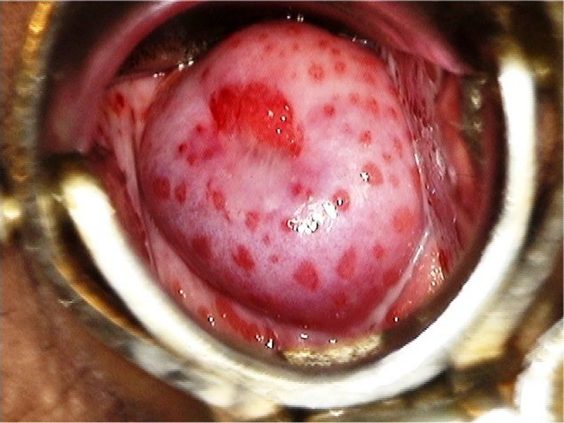 Exame especular, evidenciando o “colo em framboesa” ou “colo em morango”. Fonte: WHO (https://screening.iarc.fr/atlascolpodiag_detail.php?Id=AAHA&FinalDiag=29)