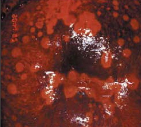 Colo “tigróide” após coloração de Schiller. Perceba que os pontos “alaranjados” não foram corados pela solução de iodo. Fonte: WHO (https://screening.iarc.fr/colpochap.php?lang=4&chap=9.php)