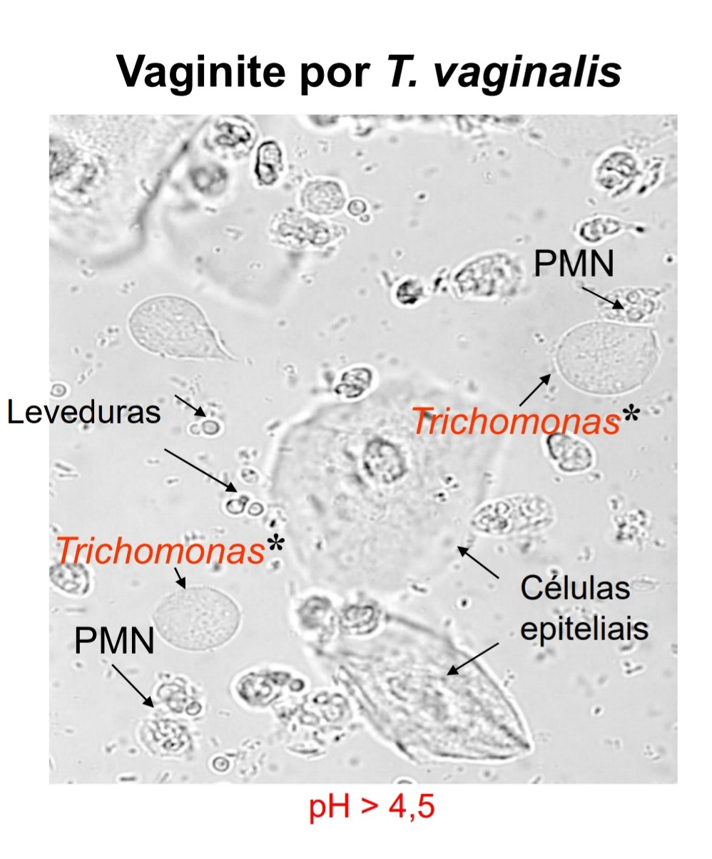 Microscopia a fresco, evidenciando a presença de Trichomonas. Fonte: Edisciplinas USP (https://edisciplinas.usp.br/pluginfile.php/5383410/mod_resource/content/1/Parasita%20trato%20genital_%20Irene%20Soares%20%5BFCF-USP%5D.pdf)
