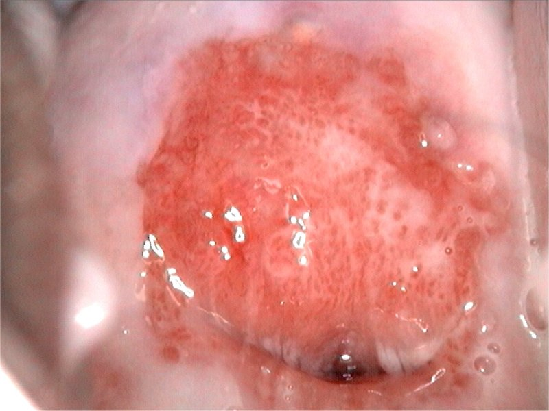 Visualização do colo uterino com achado de conteúdo homogêneo, bolhoso e acizentado. Muito sugestivo de vaginose bacteriana. Fonte: WHO (https://screening.iarc.fr/atlascolpodetail.php?Index=31&e=,0,1,2,3,8,10,15,19,30,31,43,46,47,60,61,68,73,83,88,89,93,96,102,105,111)