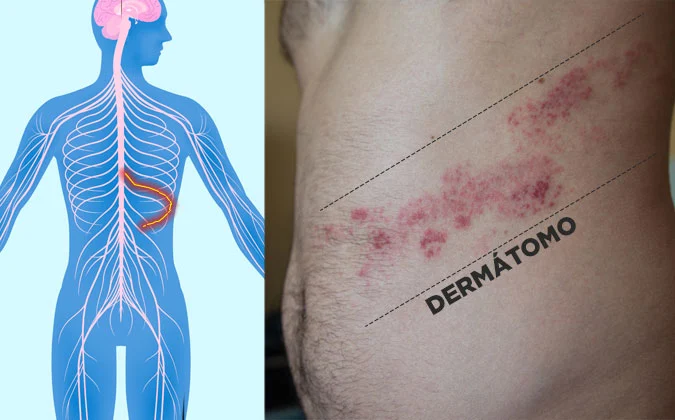 Imagem ilustrando a lesão típica da herpes-zóster. Perceba que as vesículas “seguem” o trajeto do dermátomo. Fonte: MD Saúde (https://www.mdsaude.com/doencas-infecciosas/herpes-zoster/)
