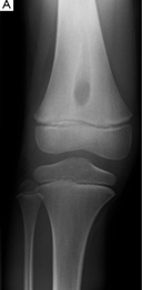 Fonte: Lee YJ, Sadigh S, Mankad K, Kapse N, Rajeswaran G. The imaging of osteomyelitis. 2016.