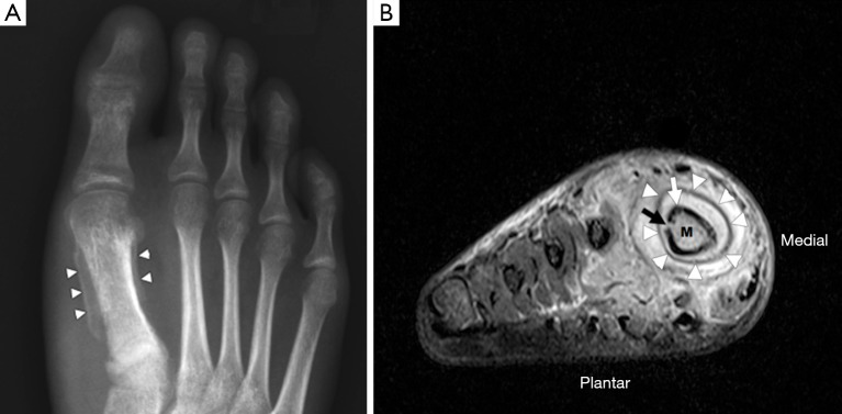Fonte: Lee YJ, Sadigh S, Mankad K, Kapse N, Rajeswaran G. The imaging of osteomyelitis. 2016.