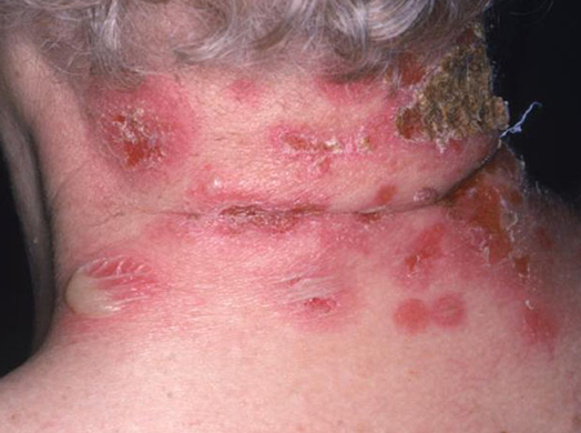 Impetigo bolhoso. Perceba que as vesículas rompem, e formam crostas marrons. Fonte: UpToDate, 2021.