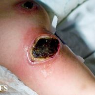 Ectima. Perceba a úlcera de crosta escura com contornos amarelos. Fonte: https://www.sbd.org.br/dermatologia/pele/doencas-e-problemas/ectima/37/