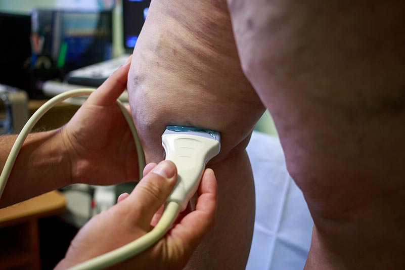 Como fazer o diagnóstico da trombose venosa profunda?