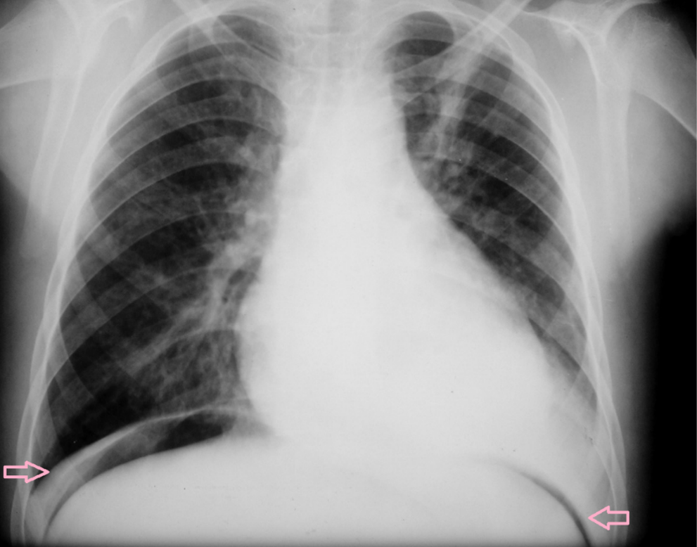 Exames de imagem para diagnóstico da doença de Crohn