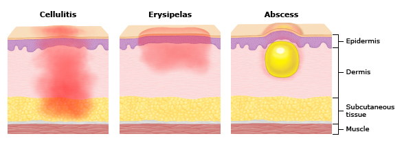 Ilustração dos planos acometidos na celulite, erisipela e abscesso. Perceba como a erisipela permanece nos planos mais superficiais, enquanto a celulite atinge os planos mais profundos da pele. Fonte: UpToDate
