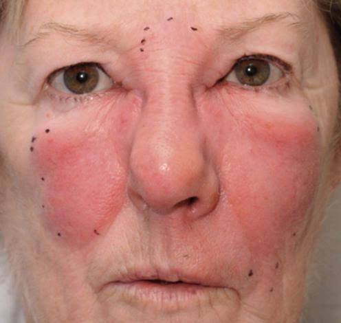 Lesão em “borboleta” na região malar. Fonte: Plastic Surgery Key (https://plasticsurgerykey.com/cellulitis-and-erysipelas/)