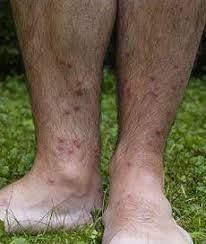 Dermatite carcariana. Fonte: Prefeitura Municipal de Dores de Guanhães (http://doresdeguanhaes.mg.gov.br/site/wp-content/uploads/2018/02/Boletim-dezembro-de-2017-Nina.pdf)