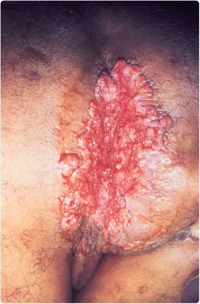Lesão por Klebsiella granulomatis. Fonte: News Medical (https://www.news-medical.net/health/Clinical-Presentation-of-Granuloma-Inguinale-(Donovanosis)-(Portuguese).aspx)