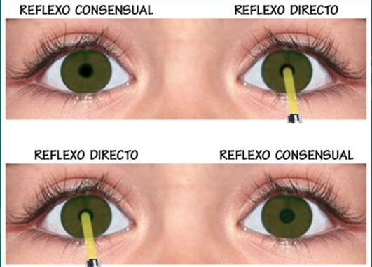 Saiba identificar os achados do reflexo pupilar