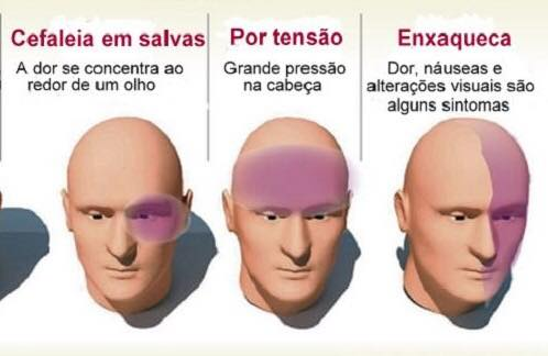Nessa imagem, a cefaleia em salvas representa o padrão de localização da dor nas cefaleias trigêmino autonômicas. Compare com o padrão de localização da dor com a cefaléia do tipo tensional e a enxaqueca. Fonte: Liga Acadêmica de Clínica Médica do Agreste (https://www.facebook.com/lacmaufpe/photos/pcb.222412881496008/222412834829346/?type=3&theater)