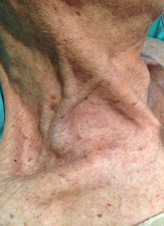 Paciente com ingurgitamento da jugular. Fonte: Questões em Cardiologia (https://www.questoesemcardiologia.com/post/2016/12/23/idoso-com-hipotens%C3%A3o-e-dispn%C3%A9ia-qual-o-diagn%C3%B3stico)