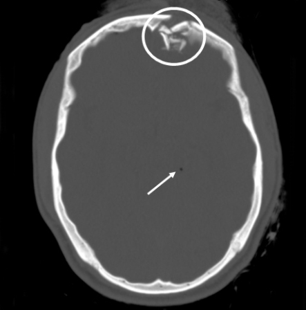 TC sem contraste de fratura craniana depressiva no osso frontal. Fonte: https://bestpractice.bmj.com/topics/pt-br/398