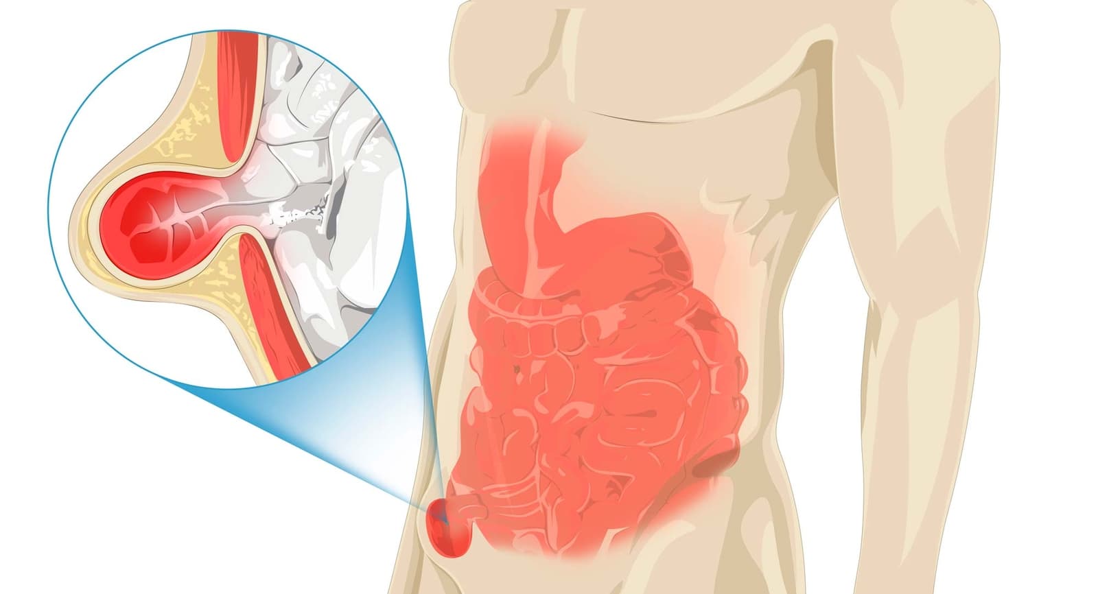 Hérnias da Região Inguinal, O que são, Sintomas e Como fazer o Diagnóstico