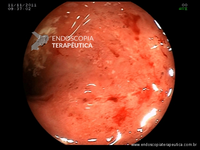 Colonoscopia de paciente com colite ulcerativa