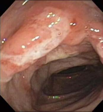 Colonoscopia para diagnóstico da doença de Crohn