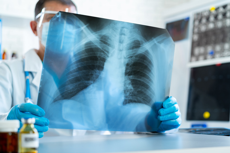 Como tratar pneumonia viral? Veja os possíveis tratamentos