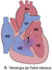 A imagem demonstra as 4 alterações clássicas da tetralogia de fallot: comunicação interventricular - CIV, hipertrofia de VD, estenose da valva pulmonar e dextroposição da aorta.Fonte: Patologia Robbins & Cotran