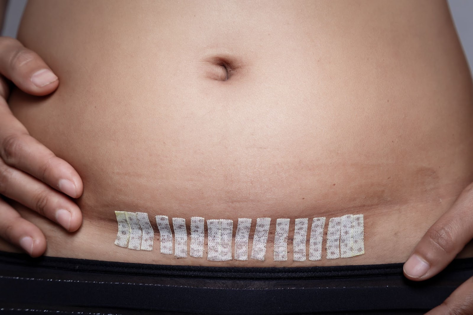 A histerectomia abdominal está passando a ser substituída pela cirurgia laparoscópica, por causar menos complicações e promover uma recuperação mais rápida. Fonte: Reprodução/AdobeStock/Weerajata